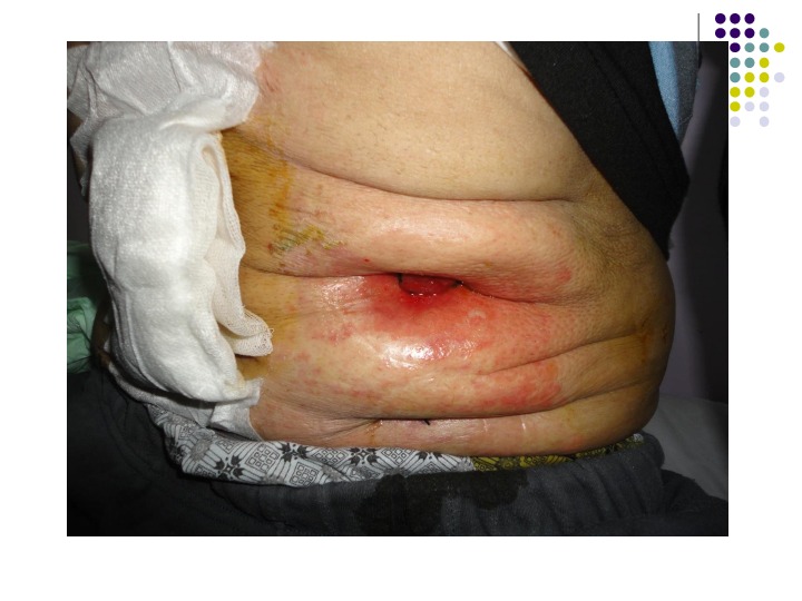 Stoma Bakımı Nasıl Yapılır Evde Yara Bakımı