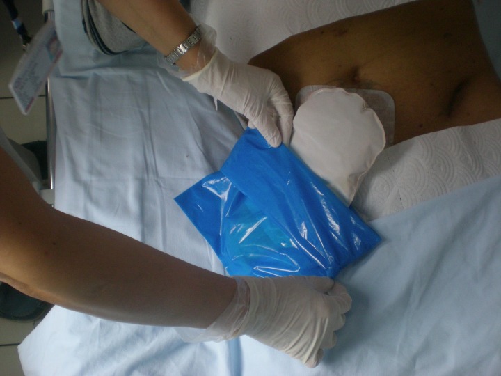 Stoma Bakımı Nasıl Yapılır Evde Yara Bakımı