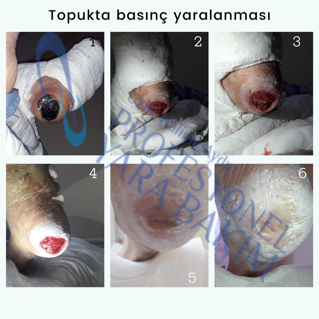 evde yara bakımı